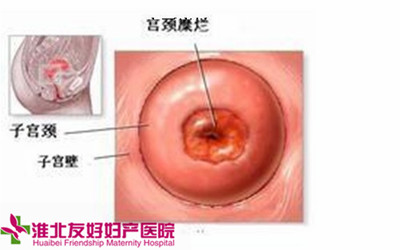 宫颈糜烂的检查方法是什么