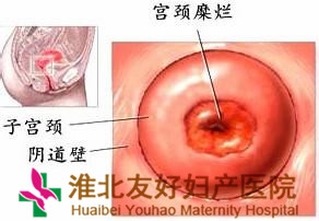 轻度宫颈糜烂 的症状表现有哪些