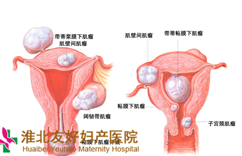 子宫肌瘤孕妇如何安度孕期