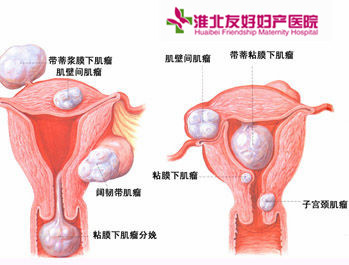 子宫肌瘤的产生原因